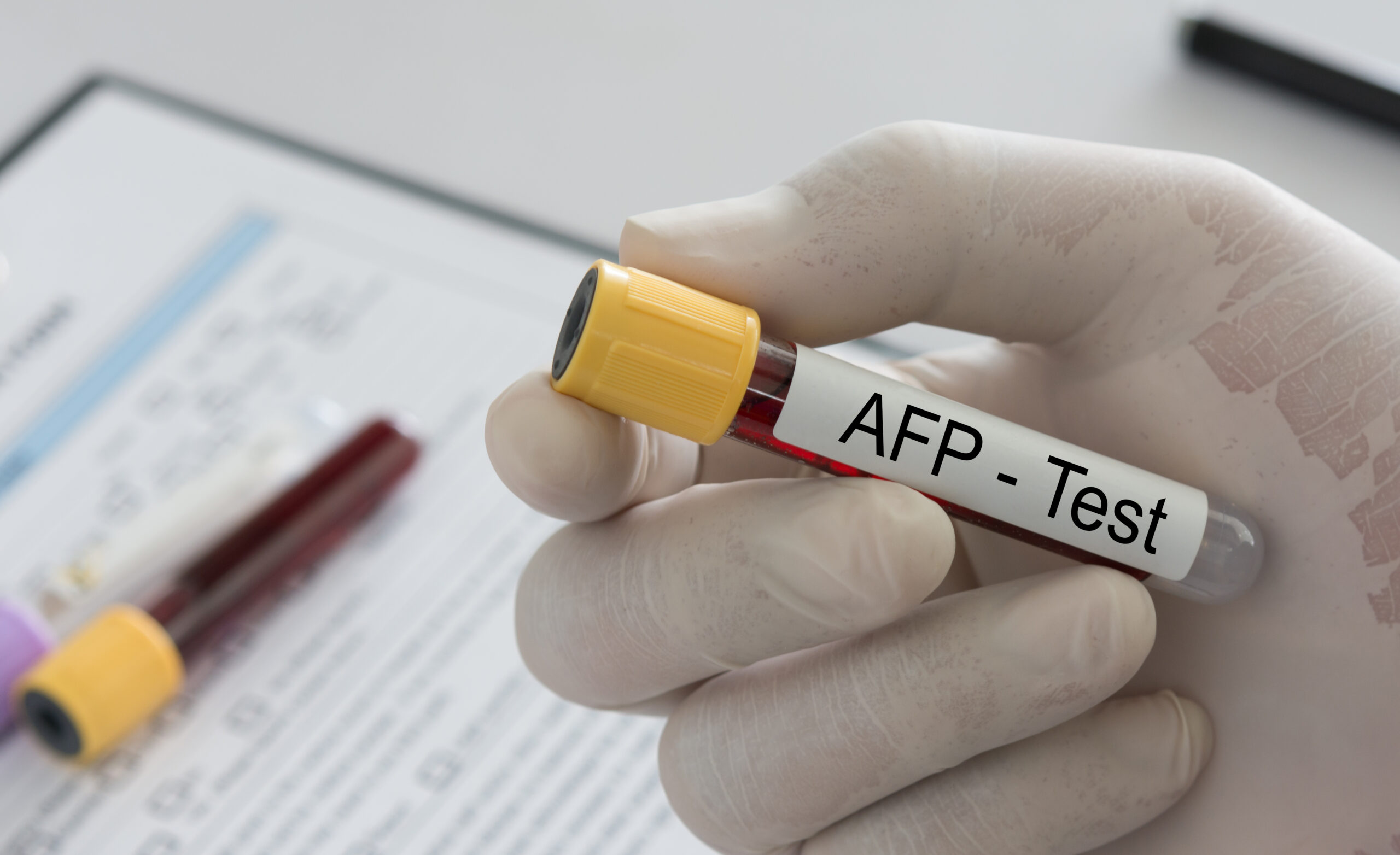 AFP Test concept. doctor holding blood sample tube to Alpha fetoprotein blood (AFP) test.