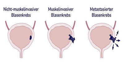 Blasenkrebs-Stadien_uid_690b318da9cbb Kopie