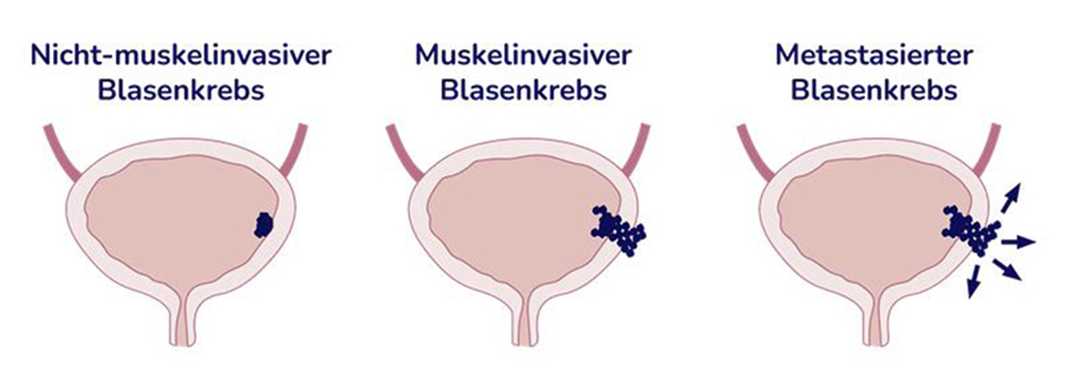 Blasenkrebs-Stadien_uid_690b318da9cbb